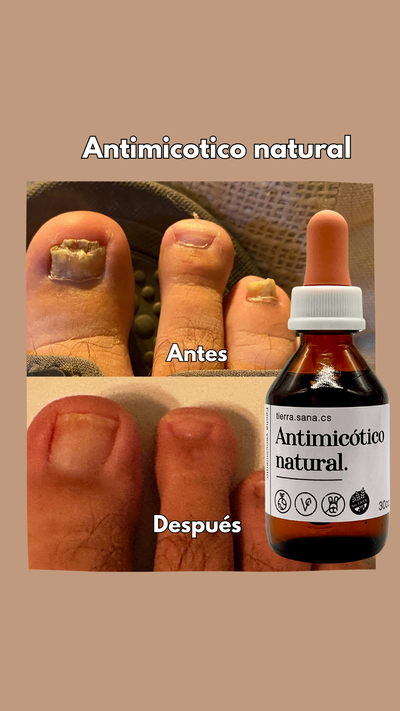 Aceite Anti hongos  uñas pies y manos