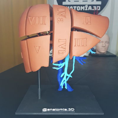Segmentacion Hepatica con Vena Porta y Vena Cava Inferior